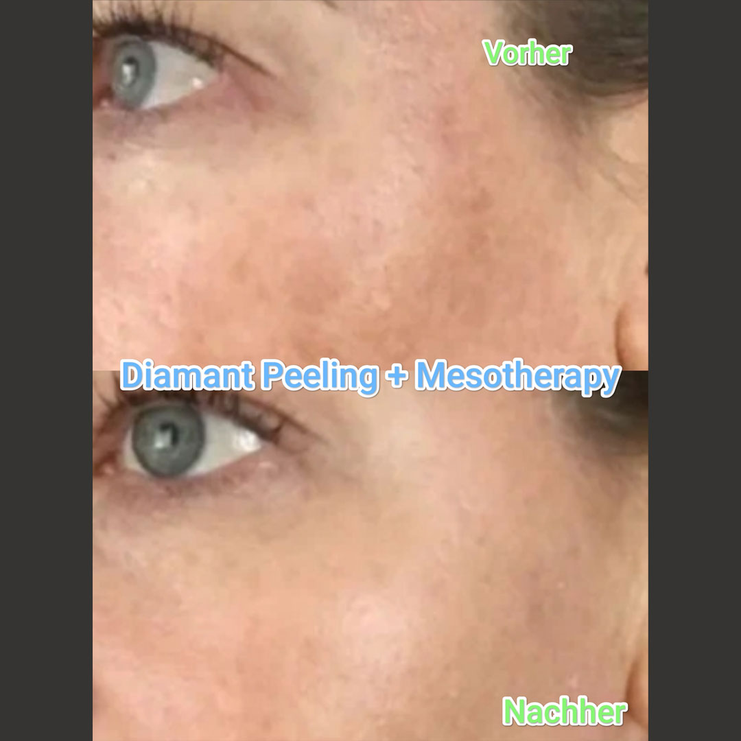 permanent-great-mesotherapy-diamant-peeling