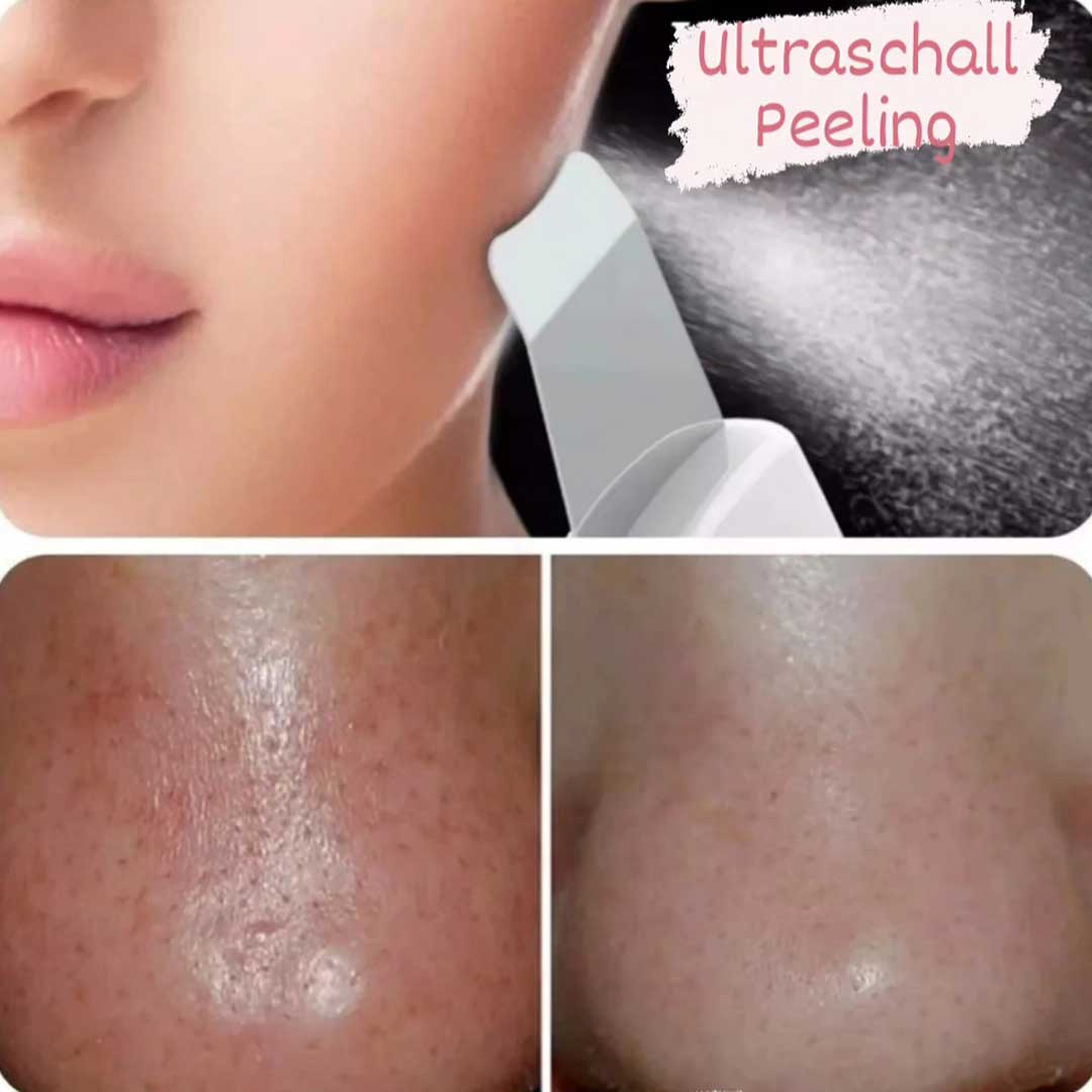 permanent-great-ultraschal-peeling